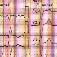 A baseline ECG shows normal sinus rhythm and an LBBB morphology with a... | Download Scientific ...