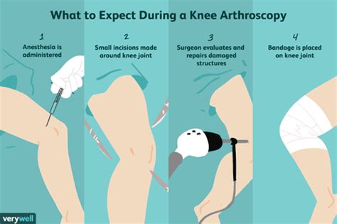 Risks and Complications of Knee Arthroscopy Surgery