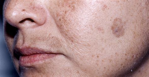 What Causes Fat Spots On Face Clearance | www.katutekno.com