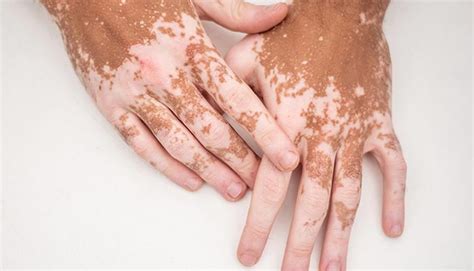 Vitiligo: Types, Symptoms, Causes, Treatment & Recovery