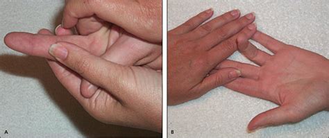 Acute Finger Injuries: Part I. Tendons and Ligaments | AAFP