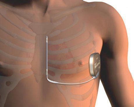 Subcutaneous Implantable Cardioverter Defibrillator | Houston Cardiology Specialists