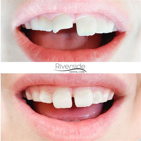 Smile Gallery - Before And After Pictures | Riverside Dental