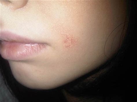 Psoriasis on face pictures | Symptoms and pictures