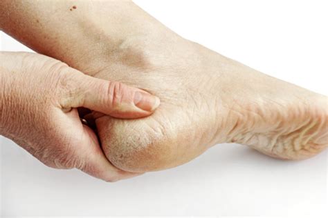 How Hyperkeratosis Can Affect Your Feet | Footfocus Podiatry