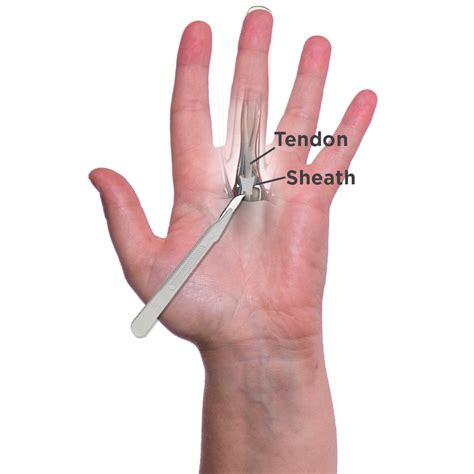 There Are Two Surgical Options to Treat Trigger Finger Pain