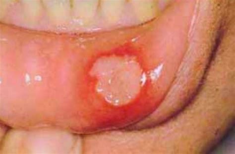 Aphthous Ulcers - Treatment, Pictures, Causes, Types, Symptoms