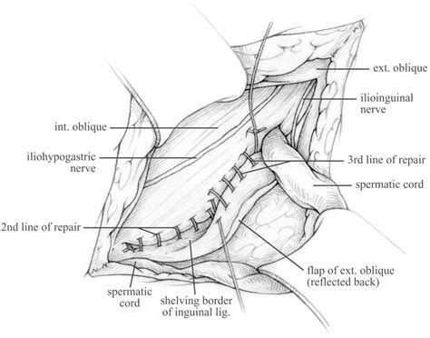 Figure 8 from The Shouldice repair for groin hernias. | Semantic Scholar