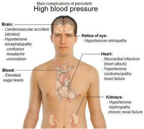 Ideal Cure...: hypertension