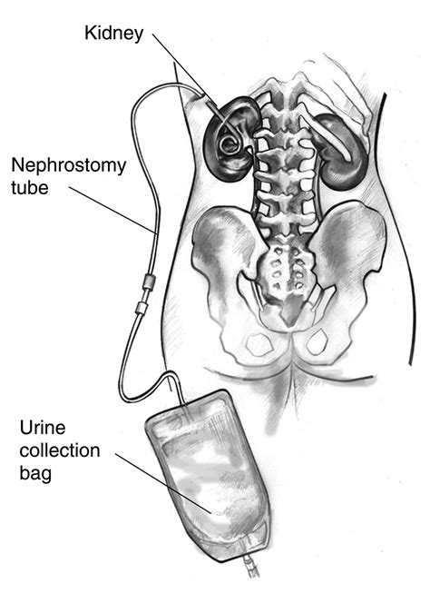 Nephrostomy – Copenhagen MedLab