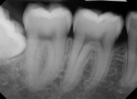 Radiology of Dental Caries | Pocket Dentistry