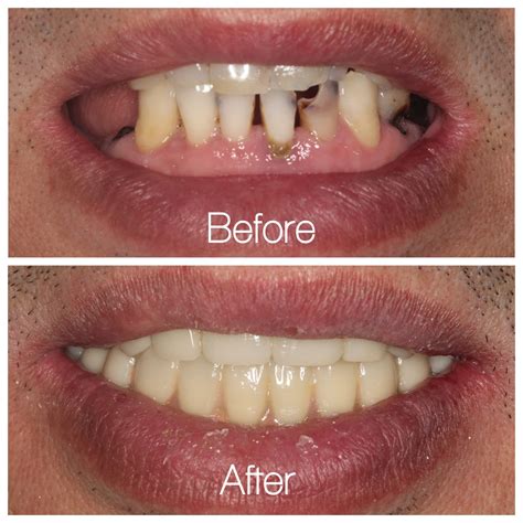 Dental Veneers Before And After : Injectable Veneers | fonewall