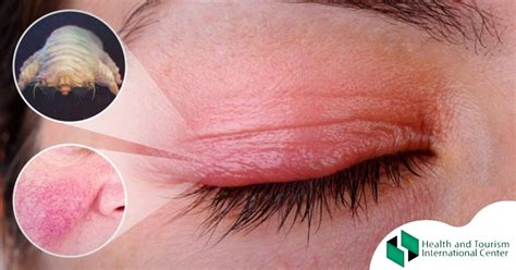 Blepharitis - Whatare the symptoms of inflammation of the eyelids? - HTI CENTERS | Medical ...
