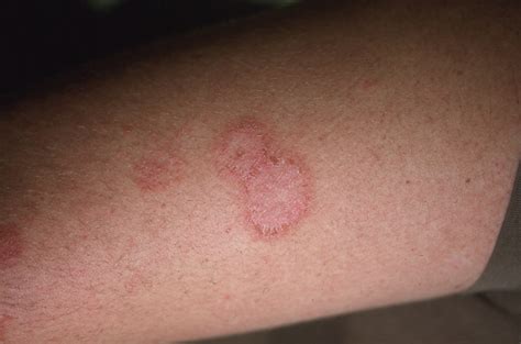 Skin Disorders Eczema Scabies Tinea Corporis Regency - vrogue.co