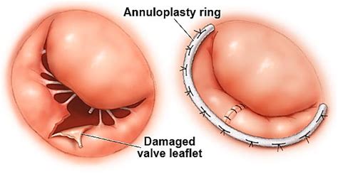 Annuloplasty - Mayo Clinic