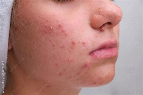 Acne. Teenage girl with the pimples on her face. Problematic skin. Close-up. Stock Photo | Adobe ...