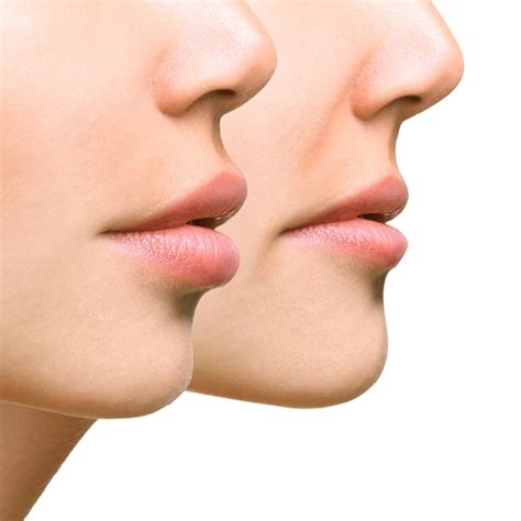 Lip Reduction Surgery In Raipur By Dr. Yatindra Dewangan | Lip Surgeon