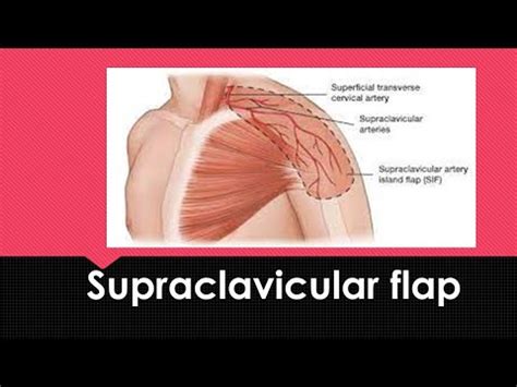 Supraclavicular flap - YouTube