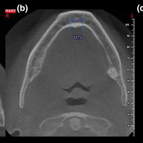 Measurement of genial tubercle width in axial section a OSA patient, b ...