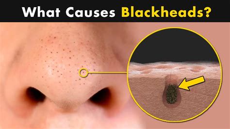 What Causes Blackheads on Our Skin? | Symptoms, Causes And Treatment - YouTube