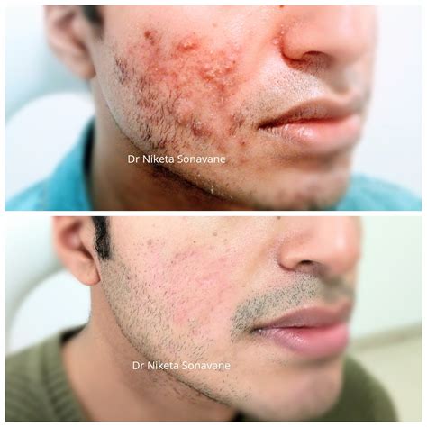 Acne Treatment In Mumbai - Cost, Before After, Laser, Acne Specialist