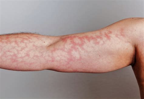 The Mottled skin | treatment | causes | symptoms