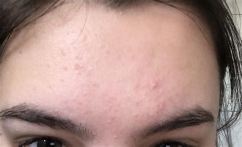 [Skin Concerns] Can dehydrated skin give you acne? : SkincareAddiction