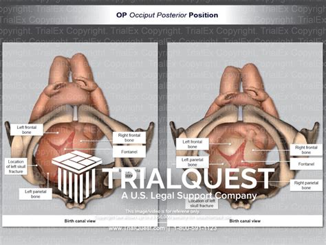 OP (Occiput Posterior) Position Birth Canal View - TrialExhibits Inc.