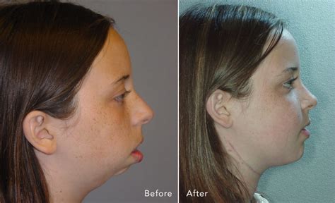 Cleft Chin Removal Before And After