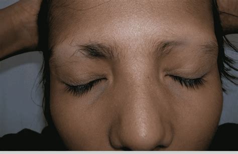 How To Identify And Prevent Eyebrow Hair Loss? | Hair Sure