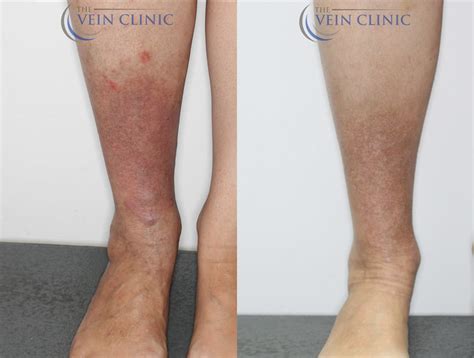 Venous Eczema Case Study Before & After - Vein Clinic Perth