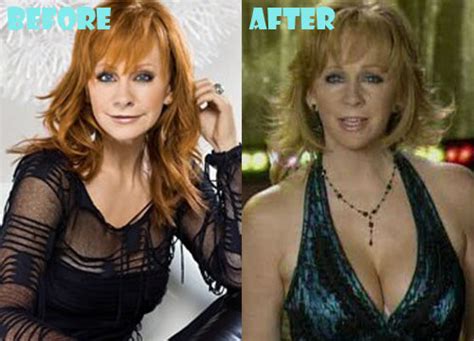 Reba McEntire Plastic Surgery Before After Pictures - Lovely Surgery | Celebrity Before and ...