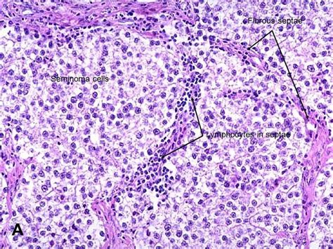 seminoma with seminomal cells and leukocytes infiltrating the septa ...