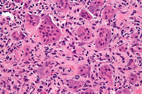 File:Giant cell tumour of bone - very high mag.jpg - Wikimedia Commons