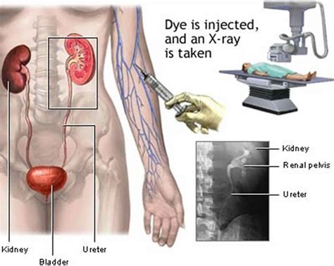 Intravenous pyelogram procedure, indications, prep, benefits & risks