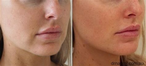 Before and after dermal filler to marionettes, jawline, chin ...