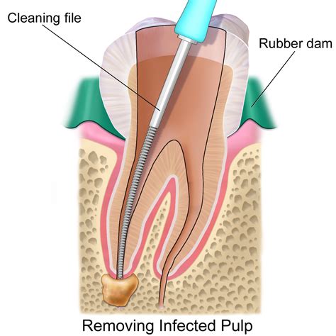 Root canal treatment - Wikipedia