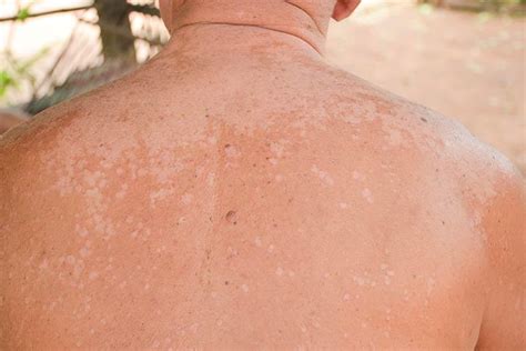 Tinea Versicolor Face