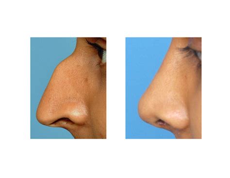 Rhinoplasty Correction of the Hook Nose Deformity - Explore Plastic Surgery