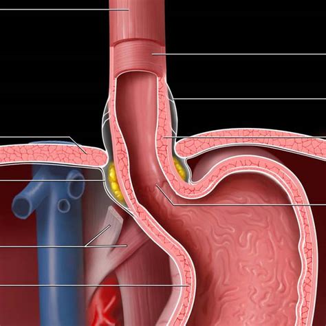 Imaging Approach to the Esophagus | Radiology Key