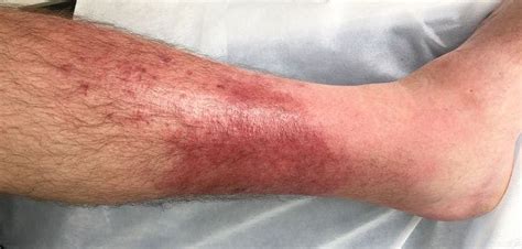 Bullous Cellulitis: Causes and Treatments - All Things Health