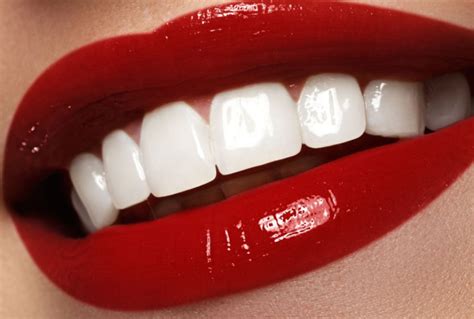 Veneers - das Hollywood - Lächeln - Evergreen Dental