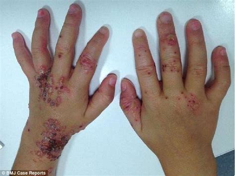 Toddler was left covered in an angry rash after catching herpes - Family World News