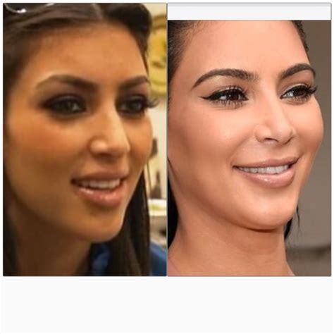 Kim kardashian nose job | Nose job, Rhinoplasty nose jobs, Kim ...