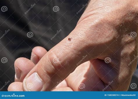 Tick on Human Hand. Ixodes Ricinus. Parasitic Mite. Dangerous Insect Mite. Encephalitis, Lyme ...