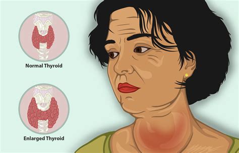 Swollen Neck Thyroid