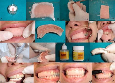 The Basics of Splinting in Dentoalveolar Traumatology | IntechOpen