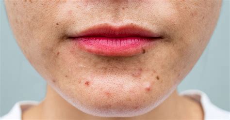 Nodular Acne: Symptoms, Causes, And How To Treat It, 41% OFF