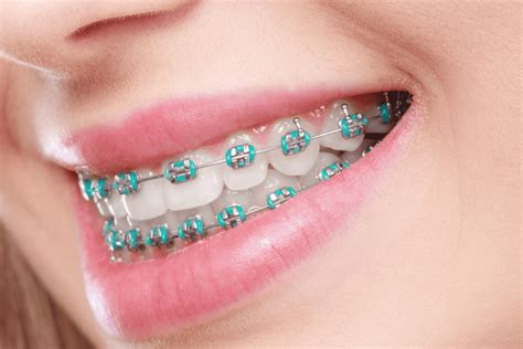 Spacers for Braces: Enhance Comfort and Effectiveness of Orthodontic Treatment