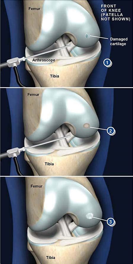 Arthroscopic Chondroplasty | Central Coast Orthopedic Medical Group